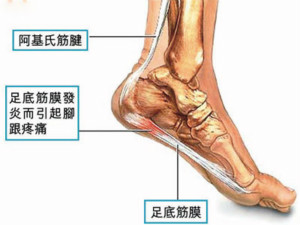 跟腱炎危害.jpg 跟腱炎危害.jpg
