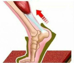 跟腱炎的典型症状.jpg 跟腱炎的典型症状.jpg