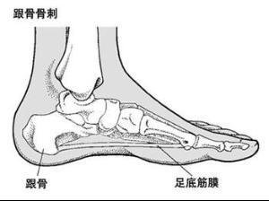 足跟骨刺 足跟骨刺