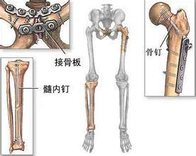 骨折2 骨折2