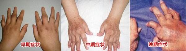 风湿性关节炎症状.jpg 风湿性关节炎症状.jpg