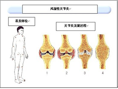 患上风湿性关节炎.jpg 患上风湿性关节炎.jpg
