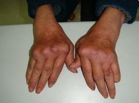 手指关节疼痛症状.jpg 手指关节疼痛症状.jpg